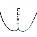 Cleft
